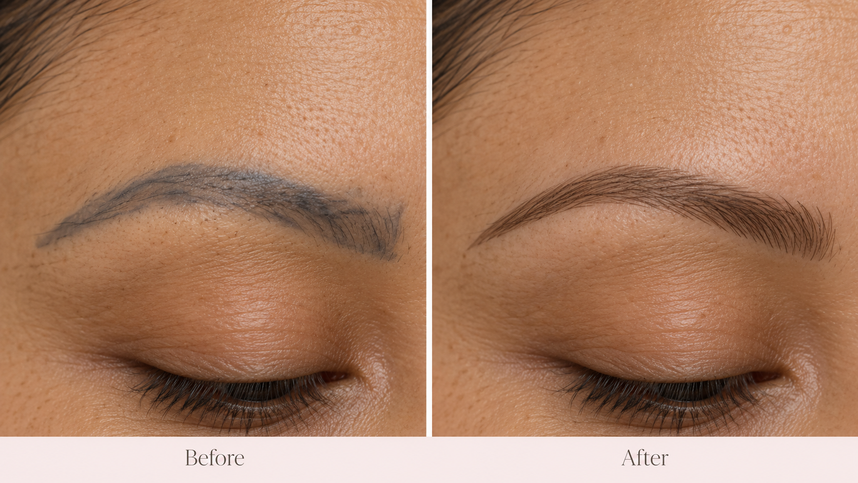 Brow correction — before and after